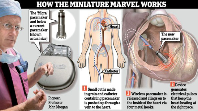 نجاح زراعة جهاز لاسلكي داخل قلب